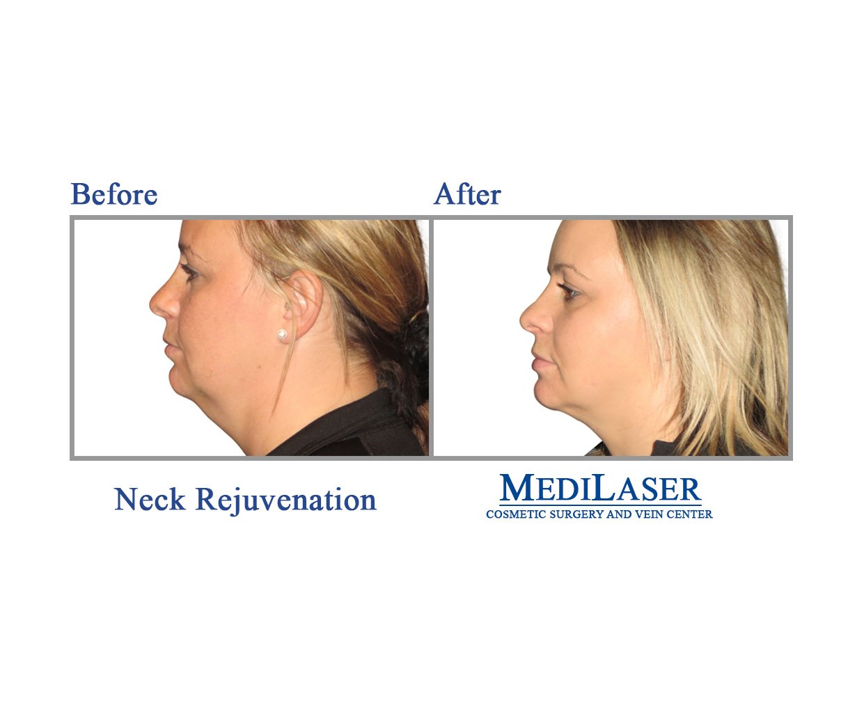 Specialty Before Afters Medilaser Surgery And Vein Center