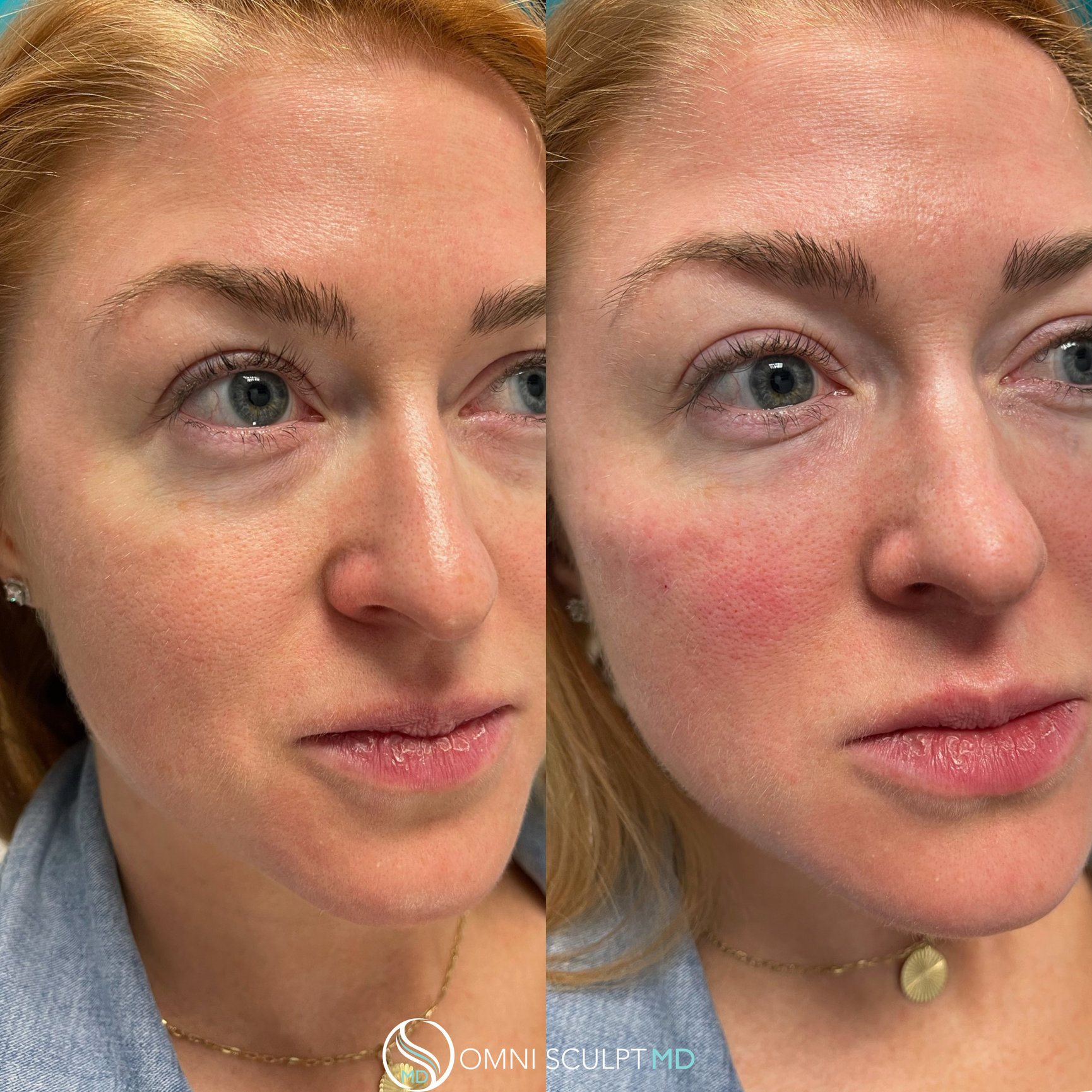 Under Eye Filler Before After Gallery OMNI SCULPT MD