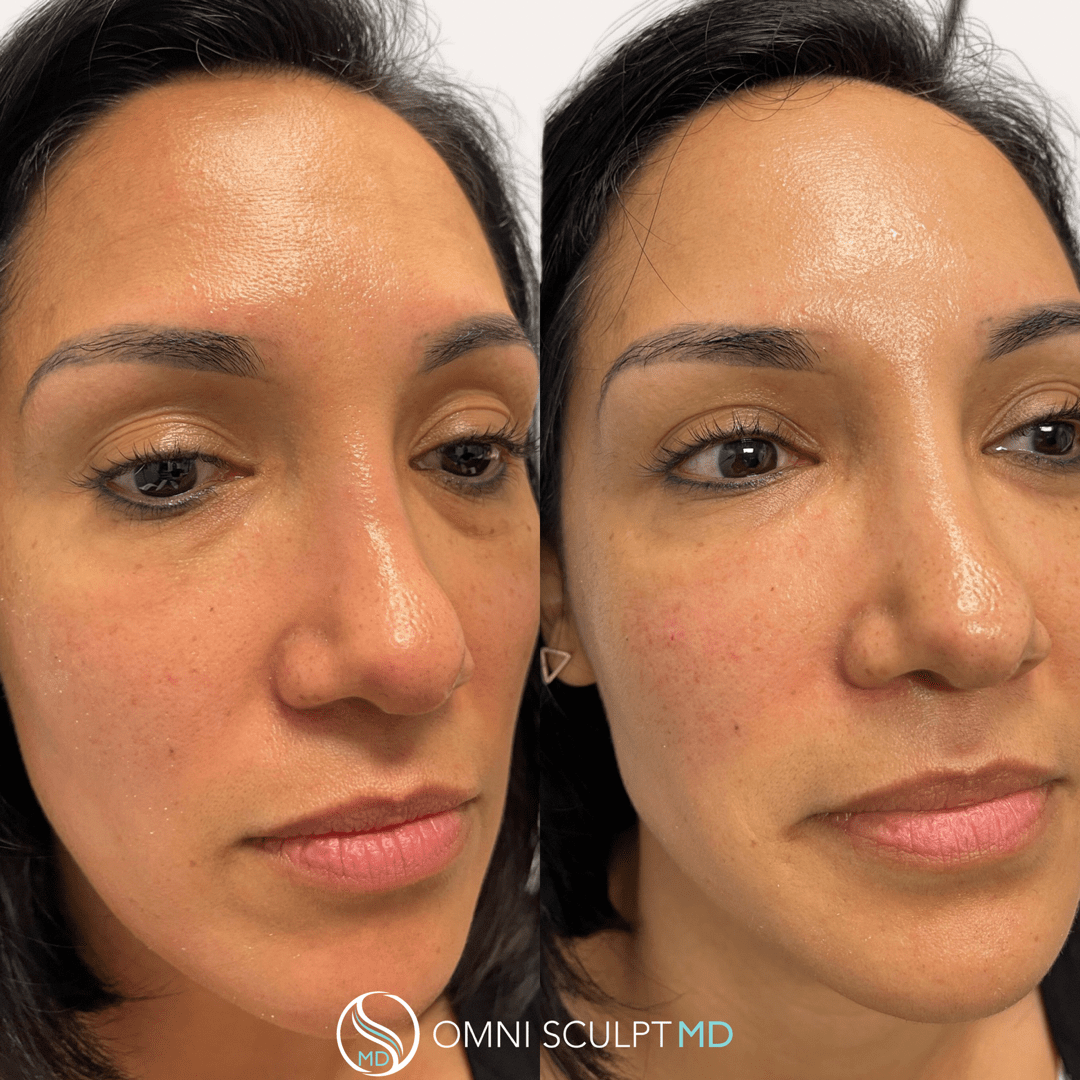 Under Eye Filler Before & After Gallery  OMNI SCULPT MD