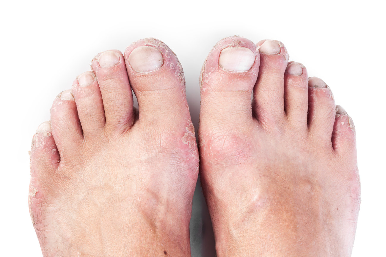 Athlete's Foot - Tinea Pedis  What Causes It & How To Treat It