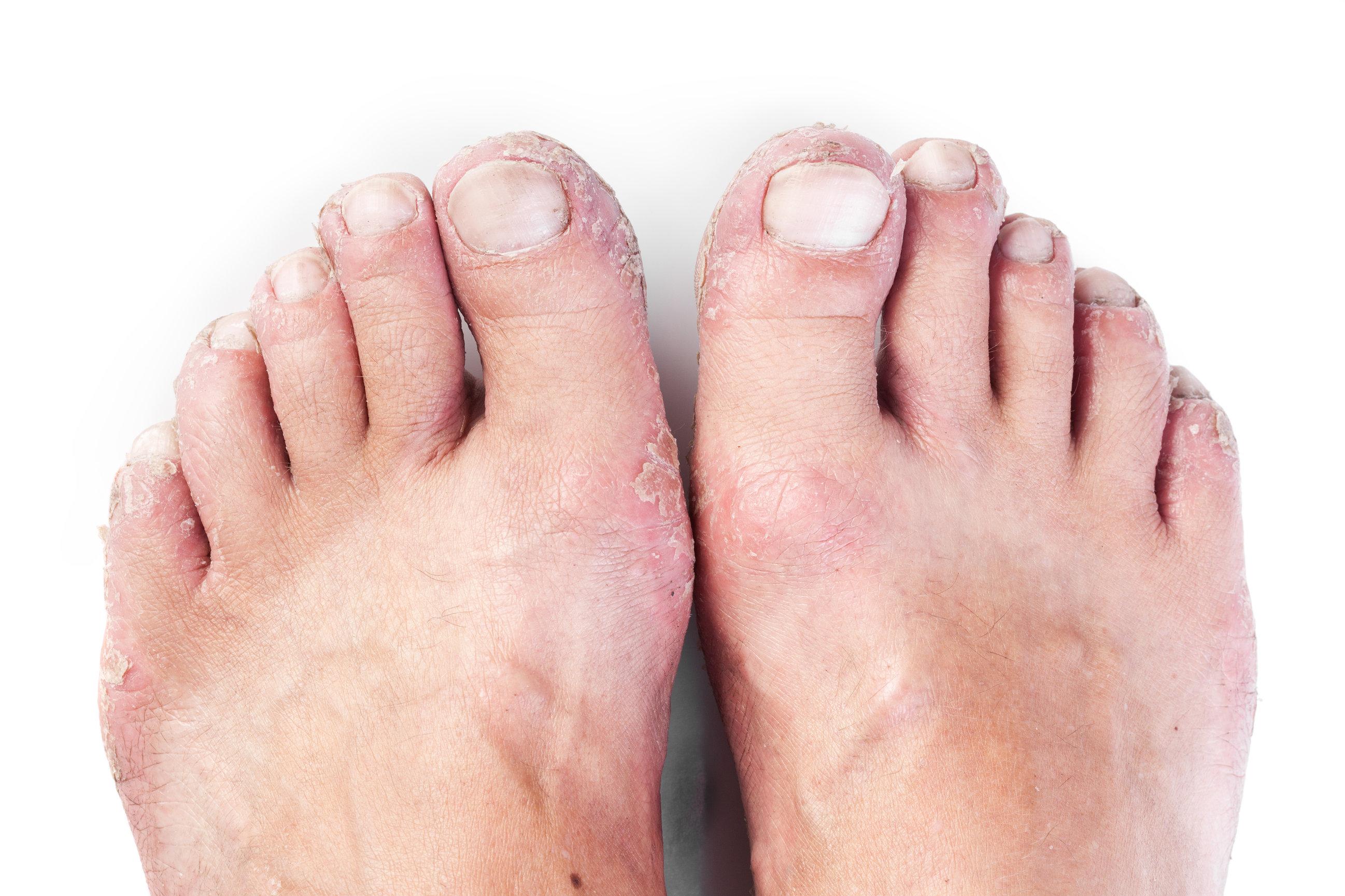 Athlete s Foot Foot Ankle Centers Of Frisco And Plano