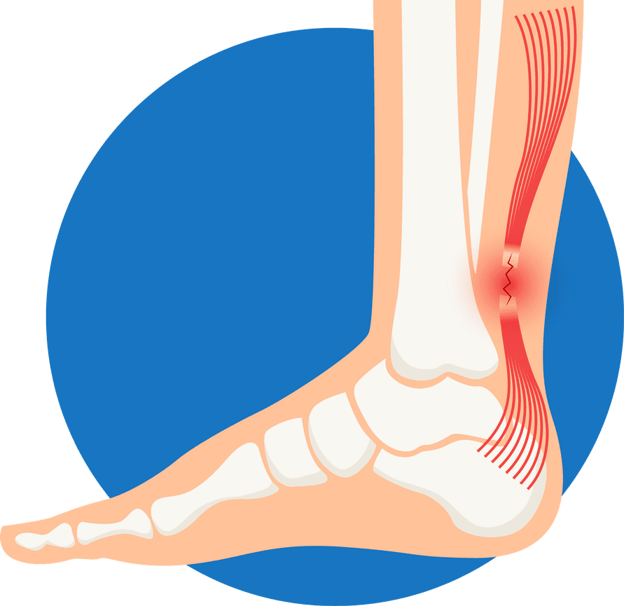 Achilles Tendon Rupture Foot Ankle Centers Of Frisco And Plano