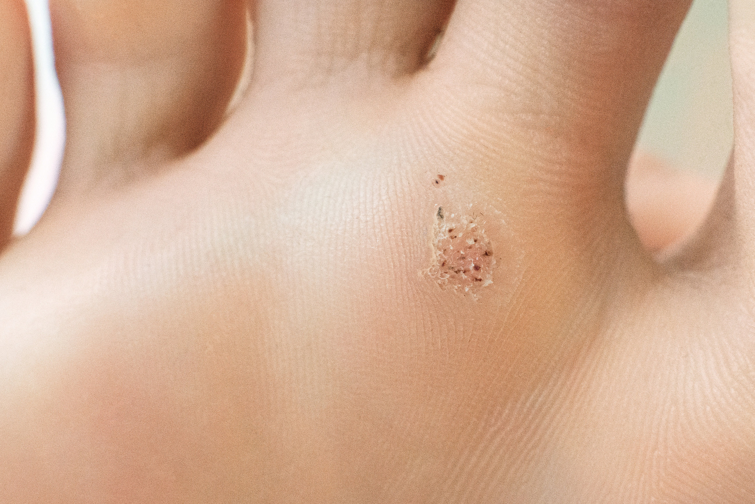 Black Dots of a Wart