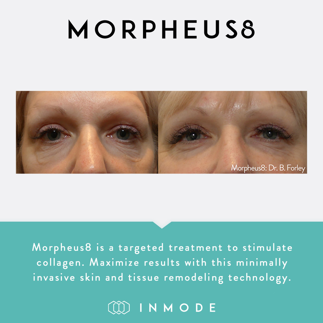 Morpheus8 Face & Body Contouring | Feel Ideal 360 Southlake