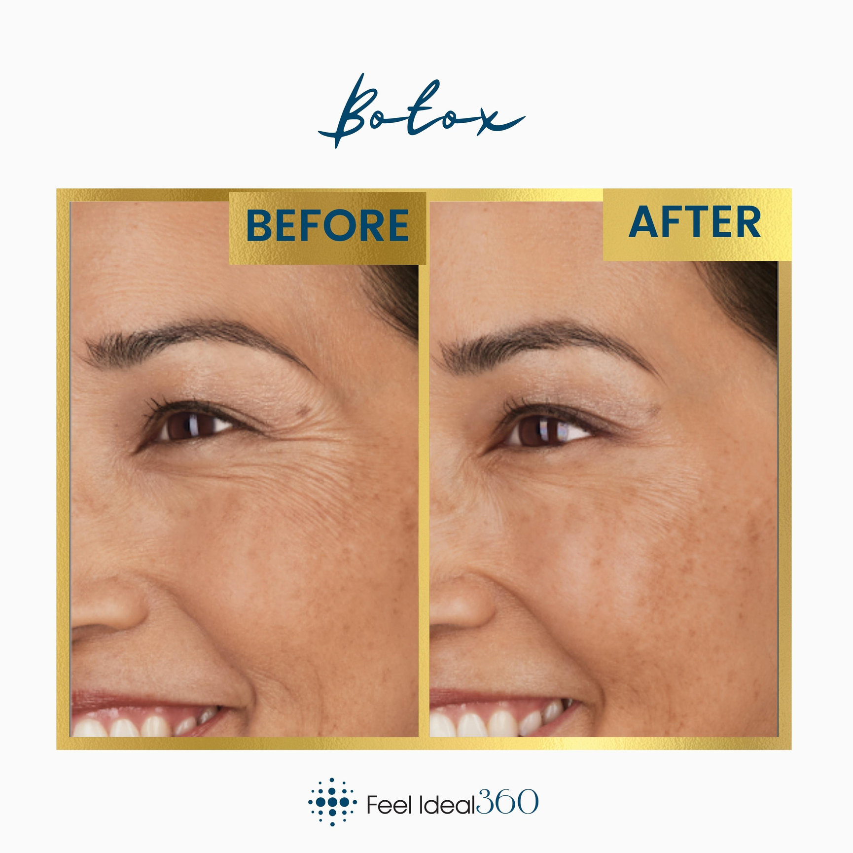 Botox Before And After Feel Ideal 360 Med Spa Southlake Tx