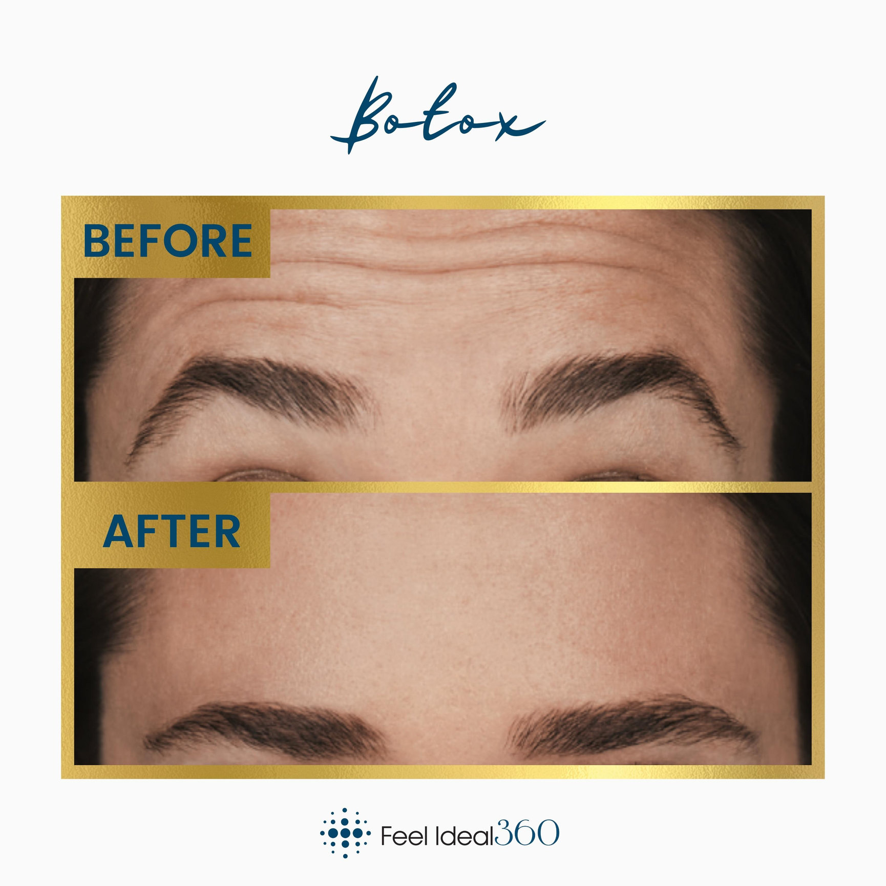 Botox Before And After Feel Ideal 360 Med Spa Southlake Tx