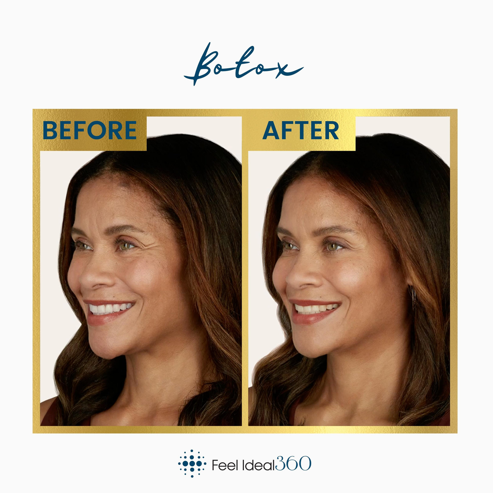 Botox Before And After Feel Ideal 360 Med Spa Southlake Tx